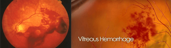 Homeopathy Medicine For Eye Vision - Vitreous Hemorrhage